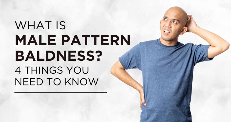What is Male Pattern Baldness? 4 Things You Need to Know